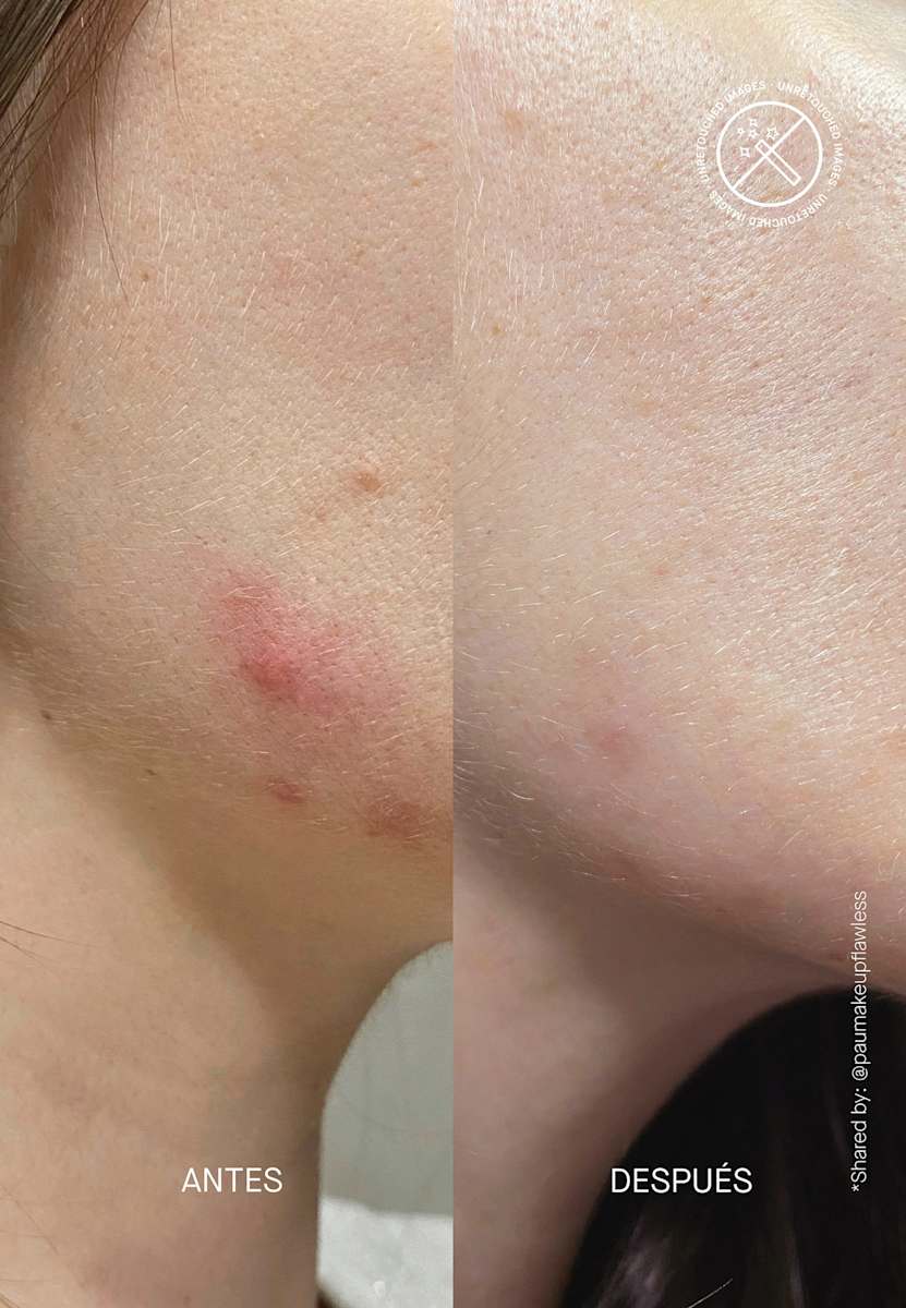 Acnemy Postzit Serum - view 5