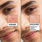 GARNIER Serum Salicylic Hautklar 7-Day Clinical Anti-Blemish, 30 ml