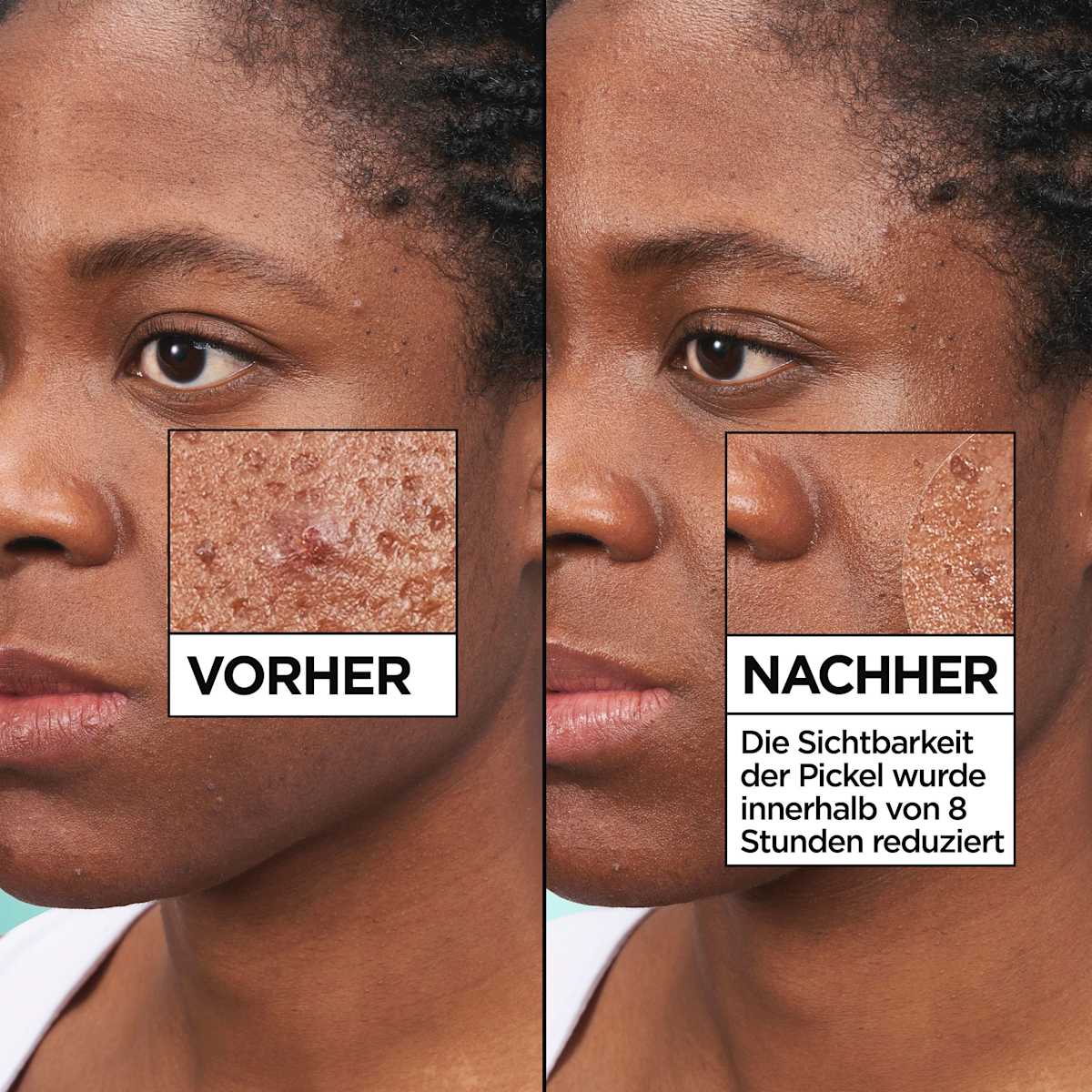 Garnier Skin Active Anti-Pimple Patches Invisible - view 5